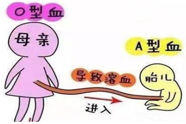 a型血和o型血生的孩子 溶血症是硬性还是显性