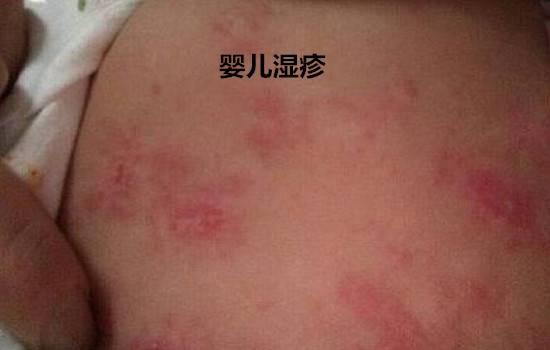 婴儿湿疹和热疹的区别 牢记六大区别不再混淆