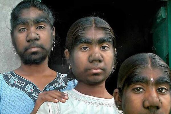 狼人综合征真的会咬人吗真的存在吗，为什么会得狼人综合征