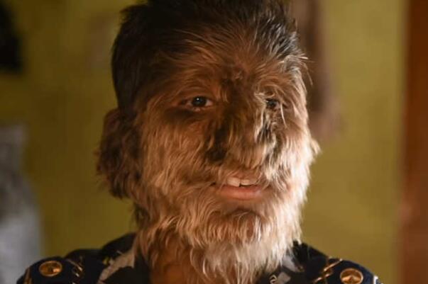 狼人综合征真的会咬人吗真的存在吗，为什么会得狼人综合征