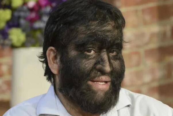 狼人综合征真的会咬人吗真的存在吗，为什么会得狼人综合征