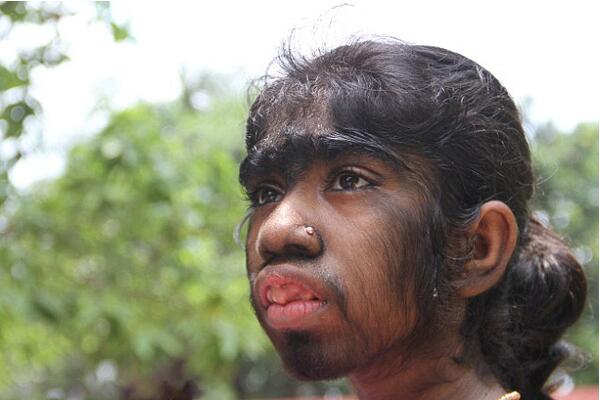 狼人综合征真的会咬人吗真的存在吗，为什么会得狼人综合征