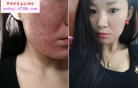 王荷祛痘是真的吗有没有效果用的是什么祛痘产品多少钱