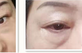 石家庄人人美万瑞医疗美容怎么样靠谱吗？女子祛眼袋术后眼闭不紧