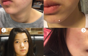 娇舒清净颜霜管用吗效果好吗真的好吗什么价位对祛痘有用吗？