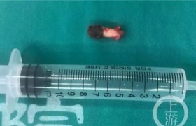 女孩鼻腔里长牙是怎么回事得了什么病？