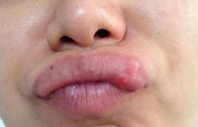 嘴上起泡是啥原因怎么可以快速1天消除，口腔为什么会得溃疡