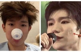 王源最近发生了什么事情，王源的脸上为什么长了这么多痘痘