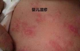 湿疹和热疹的区别图片有什么不同症状怎么缓解？