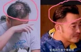 沙溢秃顶后又不秃顶了很多是怎么回事，沙溢戴假发了吗？