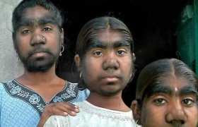 狼人综合征真的会咬人吗真的存在吗，为什么会得狼人综合征