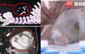男婴腹中藏寄生胎是怎么回事怎么解决后来怎么样了都活了吗