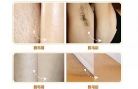 激光脱毛6年后后悔了是真的吗？激光脱毛有什么后遗症和坏处？